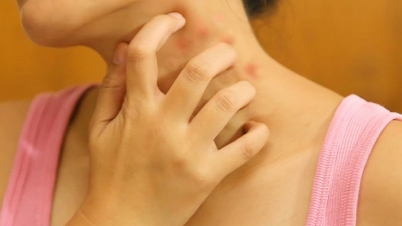 চিরতরে অ্যালার্জিকে জানান বিদায় চিরতরে অ্যালার্জিকে জানান বিদায়