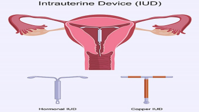 গর্ভনিরোধক যন্ত্র বসানোই আছে শরীরে!