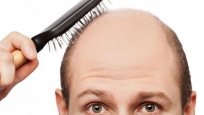 টাক মাথায় করোনা ভাইরাসের উপসর্গ গুরুতর!