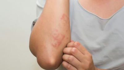 সোয়েটার কি ত্বকে র‍্যাশ তৈরি করছে? কারণ জানুন