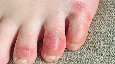 করোনায় ত্বক বিবর্ণ হয়ে র্যাশ উঠে যায় করোনায় ত্বক বিবর্ণ হয়ে র্যাশ উঠে যায়